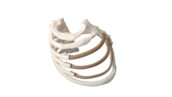 PEEK thoracic rib implant 3D printed with INTAMSYS FUNMAT PRO 610